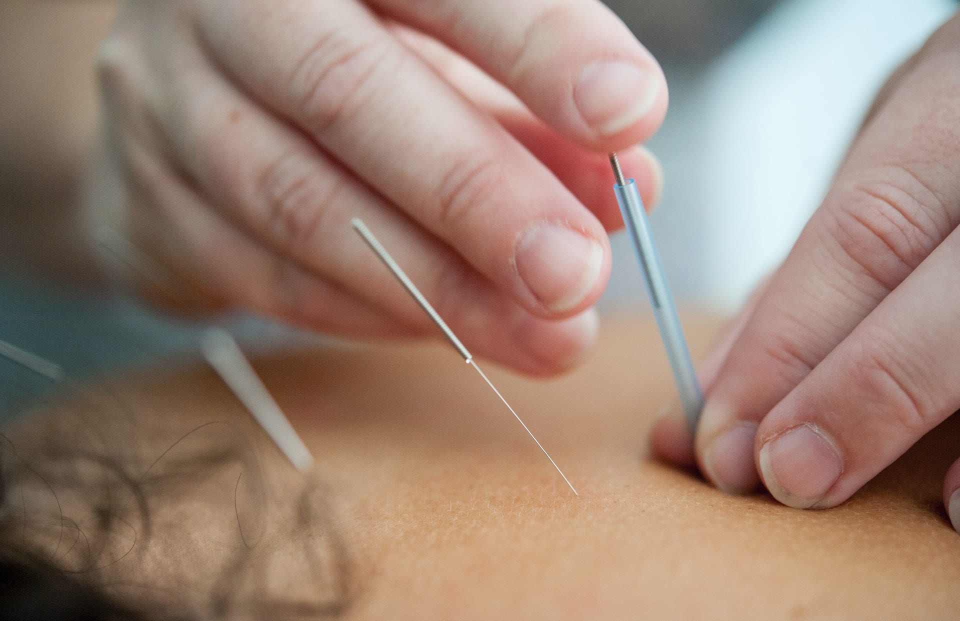 Akupunktura – dlaczego warto na nią postawić?